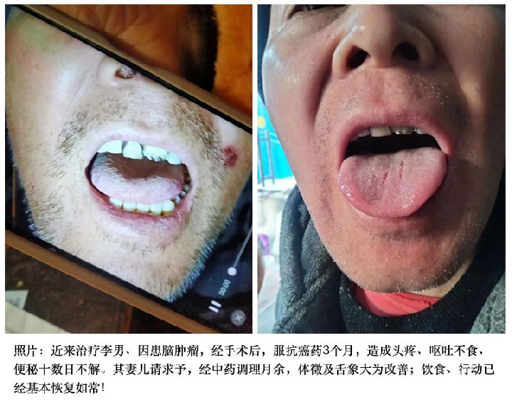 近来治疗李男 4合图.jpg
